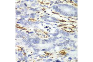 Immunohistochemistry of paraffin-embedded human gastric cancer using CALD1 antibody at dilution of 1:100 (x40 lens). (Caldesmon anticorps)