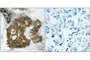 Immunohistochemistry (IHC) image for anti-V-Akt Murine Thymoma Viral Oncogene Homolog 2 (AKT2) (pSer474) antibody (ABIN2888354) (AKT2 anticorps  (pSer474))