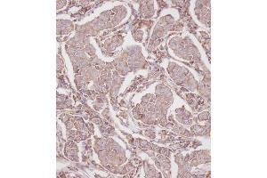 Immunohistochemical analysis of B on paraffin-embedded Human breast carcinoma tissue. (RPL23A anticorps  (C-Term))