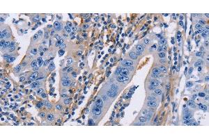 Immunohistochemistry of paraffin-embedded Human gastric cancer using CD54 Polyclonal Antibody at dilution of 1:30 (ICAM1 anticorps)