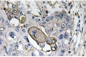 Immunohistochemistry analysis of AQP5 Antibody in paraffin-embedded human lung carcinoma tissue. (Aquaporin 5 anticorps)