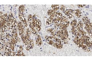 Human parathyroid adenoma: immunohistochemical staining for Parathyroid Hormone. (PTH anticorps)