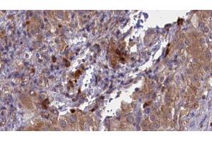 ABIN6277051 at 1/100 staining Human liver cancer tissue by IHC-P. (CD33 anticorps  (C-Term))
