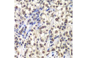 Immunohistochemistry of paraffin-embedded human kidney cancer using CENPC antibody (ABIN5973936) at dilution of 1/200 (40x lens). (Centromere Protein C Pseudogene 1 (CENPCP1) anticorps)