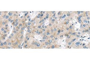 Immunohistochemistry of paraffin-embedded Human liver cancer using VPS26A Polyclonal Antibody at dilution of 1/40 (VPS26A anticorps)