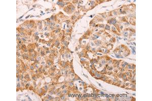 Immunohistochemistry of Human lung cancer using GNA11 Polyclonal Antibody at dilution of 1:40 (GNA11 anticorps)