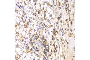 Immunohistochemistry of paraffin-embedded human kidney cancer using SRPK1 antibody. (SRPK1 anticorps)