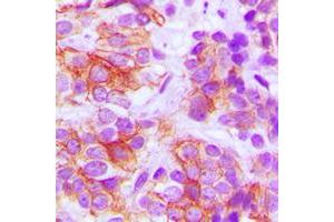 Immunohistochemical analysis of Frizzled 5 staining in human breast cancer formalin fixed paraffin embedded tissue section. (FZD5 anticorps  (C-Term))