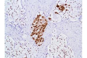 Immunohistochemistry of Human Prostate Adenocarcinoma stained with anti-Androgen Receptor (AR) antibody (Androgen Receptor anticorps  (N-Term))