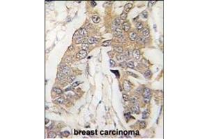 Formalin-fixed and paraffin-embedded human breast carcinoma tissue reacted with CASC3 Antibody (C-term) (ABIN391401 and ABIN2841404) , which was peroxidase-conjugated to the secondary antibody, followed by DAB staining. (CASC3 anticorps  (AA 206-236))