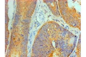 Immunohistochemical of paraffin-embedded Human Colon cancer tissue using ABIN7156047 at dilution of 1:200. (IL1A anticorps)