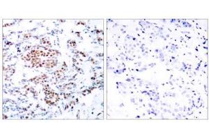 Immunohistochemical analysis of paraffin-embedded human breast carcinoma tissue using STAT5A (Ab-694) antibody (E021048). (STAT5A anticorps)