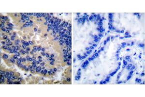 Cl-peptide - +Immunohistochemical analysis of paraffin-embedded human lung carcinoma tissue using Caspase 3 (cleaved-Asp175) antibody. (Caspase 3 anticorps  (Cleaved-Asp175))