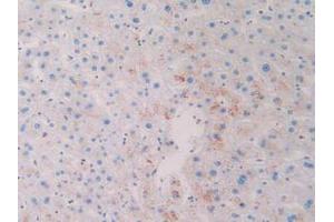 IHC-P analysis of Human Skin Cancer Tissue, with DAB staining. (CD63 anticorps  (AA 103-203))