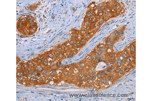 Immunohistochemistry of Human cervical cancer using MMP1 Polyclonal Antibody at dilution of 1:55 (MMP1 anticorps)