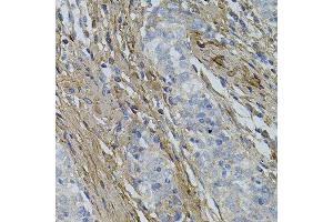 Immunohistochemistry of paraffin-embedded human esophageal cancer using COL1A1 antibody. (COL1A1 anticorps)