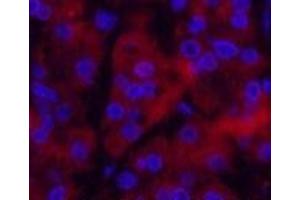 Immunofluorescence analysis of Human stomach cancer tissue using Ubiquitin Monoclonal Antibody at dilution of 1:200. (Ubiquitin anticorps)