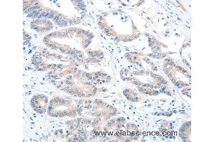 Immunohistochemistry of Human colon cancer using ALDH1A2 Polyclonal Antibody at dilution of 1:60 (ALDH1A2 anticorps)