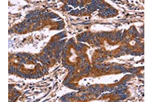 The image on the left is immunohistochemistry of paraffin-embedded Human colon cancer tissue using ABIN7129993(KIR2DL3/KIR2DL1/KIR2DL4/KIR2DS4 Antibody) at dilution 1/30, on the right is treated with fusion protein. (KIR2DL3/KIR2DL1/KIR2DL4/KIR2DS4 anticorps)