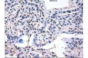 Immunohistochemical staining of paraffin-embedded Carcinoma of lung using anti-AKT3 (ABIN2452682) mouse monoclonal antibody. (AKT3 anticorps  (AA 2-479))