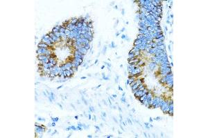 Immunohistochemistry of paraffin-embedded human colon carcinoma using NOX1 antibody (ABIN7268824) at dilution of 1:100 (40x lens). (NOX1 anticorps  (AA 200-300))