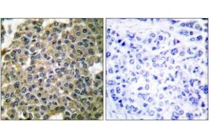 Immunohistochemistry analysis of paraffin-embedded human breast carcinoma tissue, using Keratin 7 Antibody. (Cytokeratin 7 anticorps  (AA 420-469))