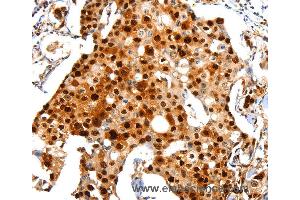 Immunohistochemistry of Human breast cancer using PCNA Polyclonal Antibody at dilution of 1:44 (PCNA anticorps)