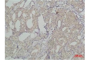 Immunohistochemical analysis of paraffin-embedded human breast caricnoma using SLUG Polyclonal Antibody. (SLUG anticorps)