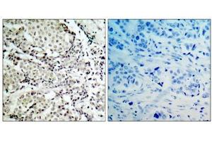 Immunohistochemical analysis of paraffin- embedded human breast carcinoma tissue, using MKK3 (Ab-189) antibody (E021116). (MAP2K3 anticorps)