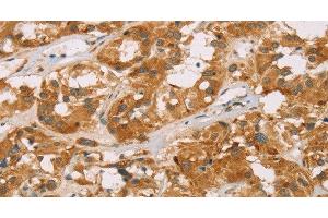 Immunohistochemistry of paraffin-embedded Human thyroid cancer tissue using DLL4 Polyclonal Antibody at dilution 1:40 (DLL4 anticorps)