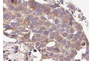 ABIN6267636 at 1/100 staining human breast carcinoma tissue sections by IHC-P. (G3BP1 anticorps  (pSer232))