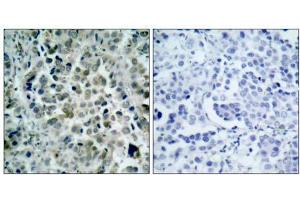 Immunohistochemical analysis of paraffin- embedded human lung carcinoma tissue, using HDAC8 (Ab-39) antibody (E021143). (HDAC8 anticorps)