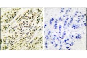 Immunohistochemistry analysis of paraffin-embedded human breast carcinoma tissue, using SKP1A/p19 Antibody. (SKP1 anticorps  (AA 41-90))