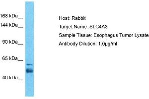 Host: Rabbit Target Name: SLC4A3 Sample Tissue: Human Esophagus Tumor Antibody Dilution: 1ug/ml (SLC4A3 anticorps  (N-Term))