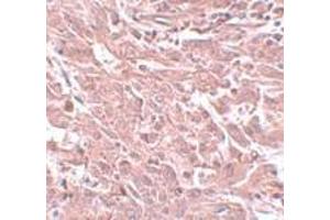 Immunohistochemistry of BCAS4 in human breast carcinoma with BCAS4 antibody at 5 μg/ml. (BCAS4 anticorps  (N-Term))