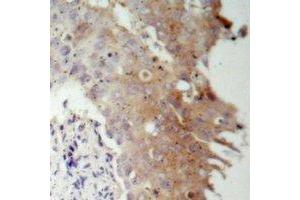 Immunohistochemical analysis of IRS1 staining in human prostate cancer formalin fixed paraffin embedded tissue section. (IRS1 anticorps)