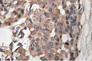 Immunohistochemistry (IHC) analyzes of Raf-B antibody in paraffin-embedded human breast carcinoma tissue. (BRAF anticorps)