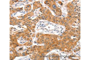 Immunohistochemistry of Human liver cancer using NUAK1 Polyclonal Antibody at dilution of 1:70 (NUAK1 anticorps)