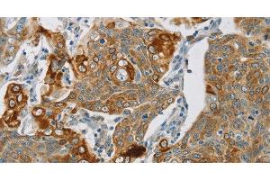 Immunohistochemistry of paraffin-embedded Human cervical cancer using SMOC2 Polyclonal Antibody at dilution of 1:30 (SMOC2 anticorps)
