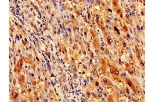 Immunohistochemistry analysis of human liver cancer using ABIN7168095 at dilution of 1:100 (Ribokinase anticorps  (AA 2-322))