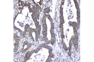 IHC testing of FFPE human colon cancer tissue with L1CAM antibody at 1ug/ml. (L1CAM anticorps)