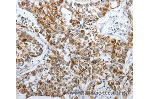 Immunohistochemistry of Human lung cancer using PDK2 Polyclonal Antibody at dilution of 1:40 (PDK2 anticorps)