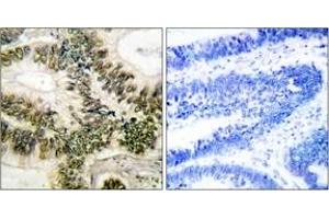 Immunohistochemistry analysis of paraffin-embedded human colon carcinoma tissue, using Cyclin E1 (Ab-395) Antibody. (Cyclin E1 anticorps  (AA 361-410))