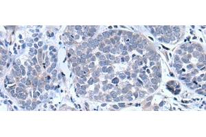 Immunohistochemistry of paraffin-embedded Human esophagus cancer tissue using BTG4 Polyclonal Antibody at dilution of 1:55(x200) (BTG4 anticorps)