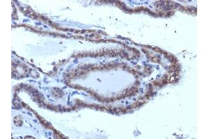 Formalin-fixed, paraffin-embedded human Thyroid Carcinoma stained with TSHRA Monoclonal Antibody (SPM223). (TSH receptor anticorps)