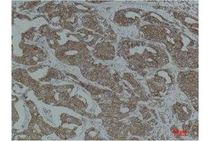 Immunohistochemistry (IHC) analysis of paraffin-embedded Human Breast Carcinoma using Calnexin Polyclonal Antibody. (Calnexin anticorps)