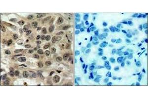 Immunohistochemistry analysis of paraffin-embedded human breast carcinoma tissue, using CDC25C (Ab-216) Antibody. (CDC25C anticorps  (AA 183-232))