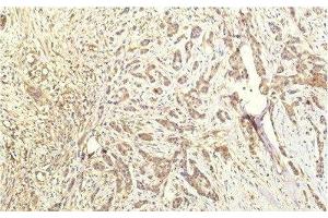 Immunohistochemistry of paraffin-embedded Human breast carcinoma tissue using STAT1 Monoclonal Antibody at dilution of 1:200. (STAT1 anticorps)