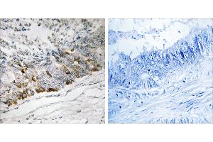 Peptide - +Immunohistochemistry analysis of paraffin-embedded human colon carcinoma tissue using GCHFR antibody. (GCHFR anticorps  (Internal Region))