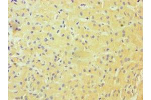 Immunohistochemistry of paraffin-embedded human liver cancer using ABIN7144985 at dilution of 1:100 (DDX3X anticorps  (AA 1-220))